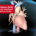 How Long Can Someone Live With Afib