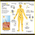 How To Diagnose Lupus Symptoms